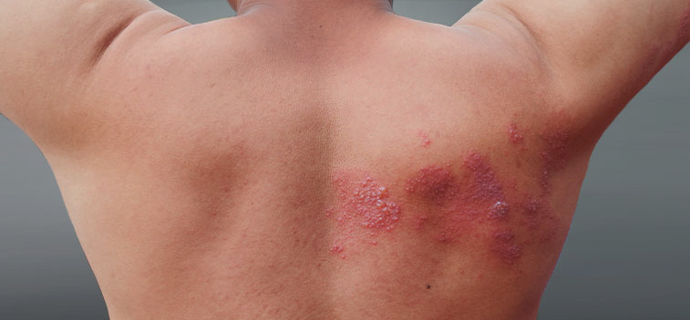 patient experiencing Post-Herpetic Neuralgia and in need of the neuropathy treatment protocol at Hifai Chiropractic in San Diego