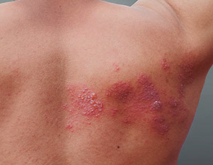 patient needing Post-Herpetic Neuralgia